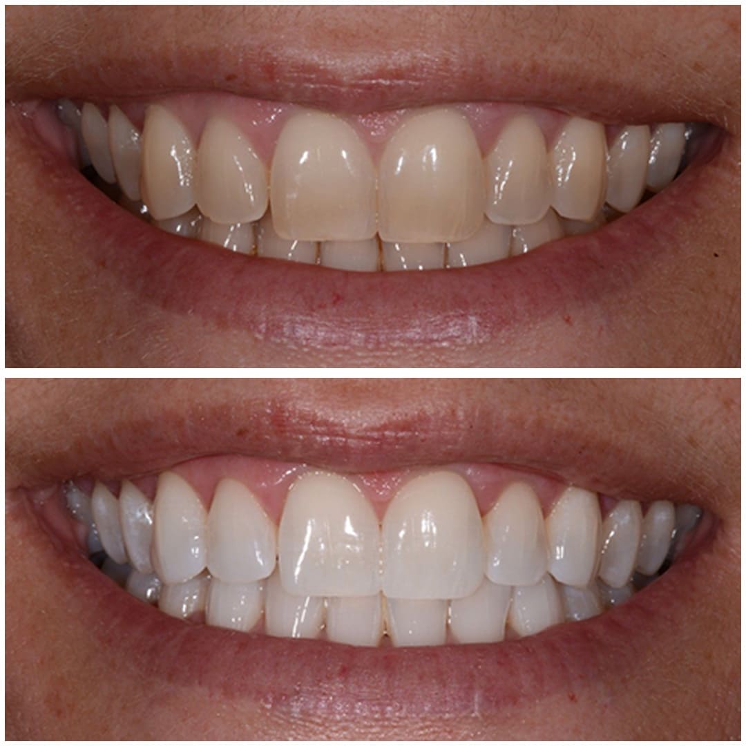 teeth whitening Andover Whitchurch Hampshire