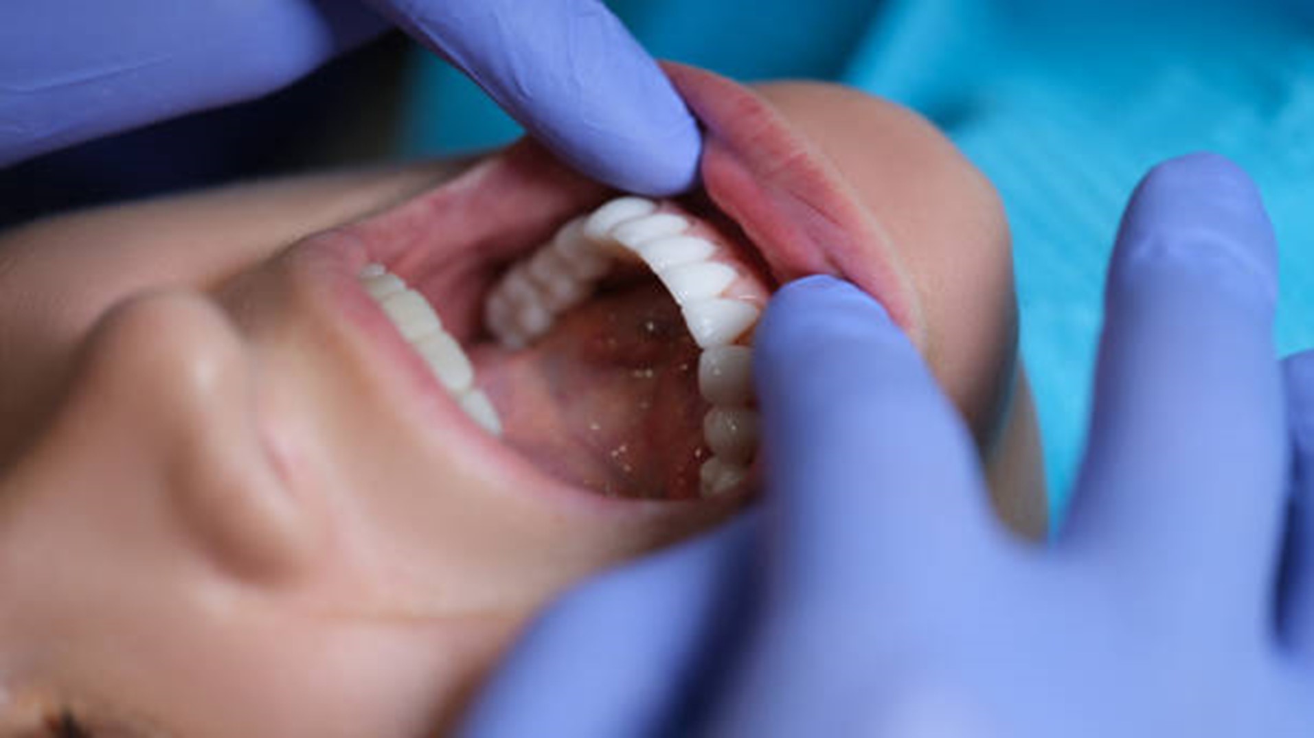 Unveiling The Beauty: 10 Facts About Veneers