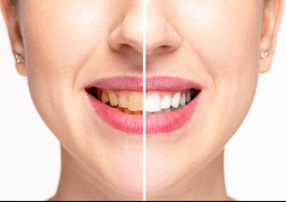 Coffee & Wine Stains on Teeth? Try Professional Whitening