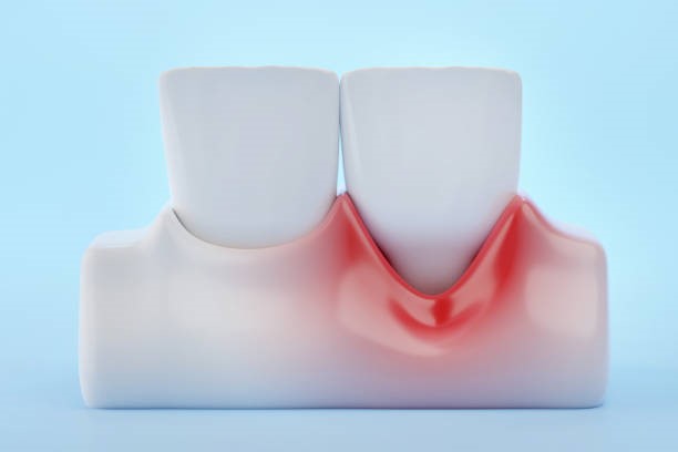 3 shocking reasons your gums could be recessing