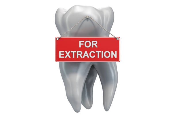 5 Signs You May Need a Tooth Extraction