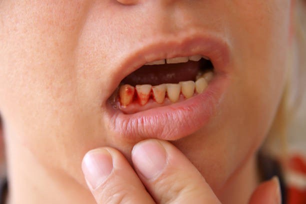 Here’s Why Your Gums Are Bleeding