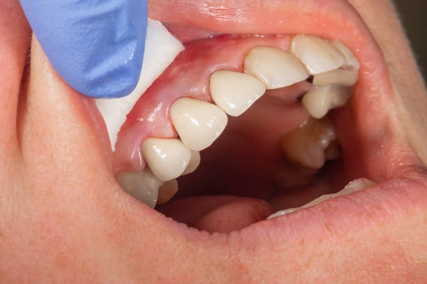 Maintaining Optimal Oral Health with Dental Bridges