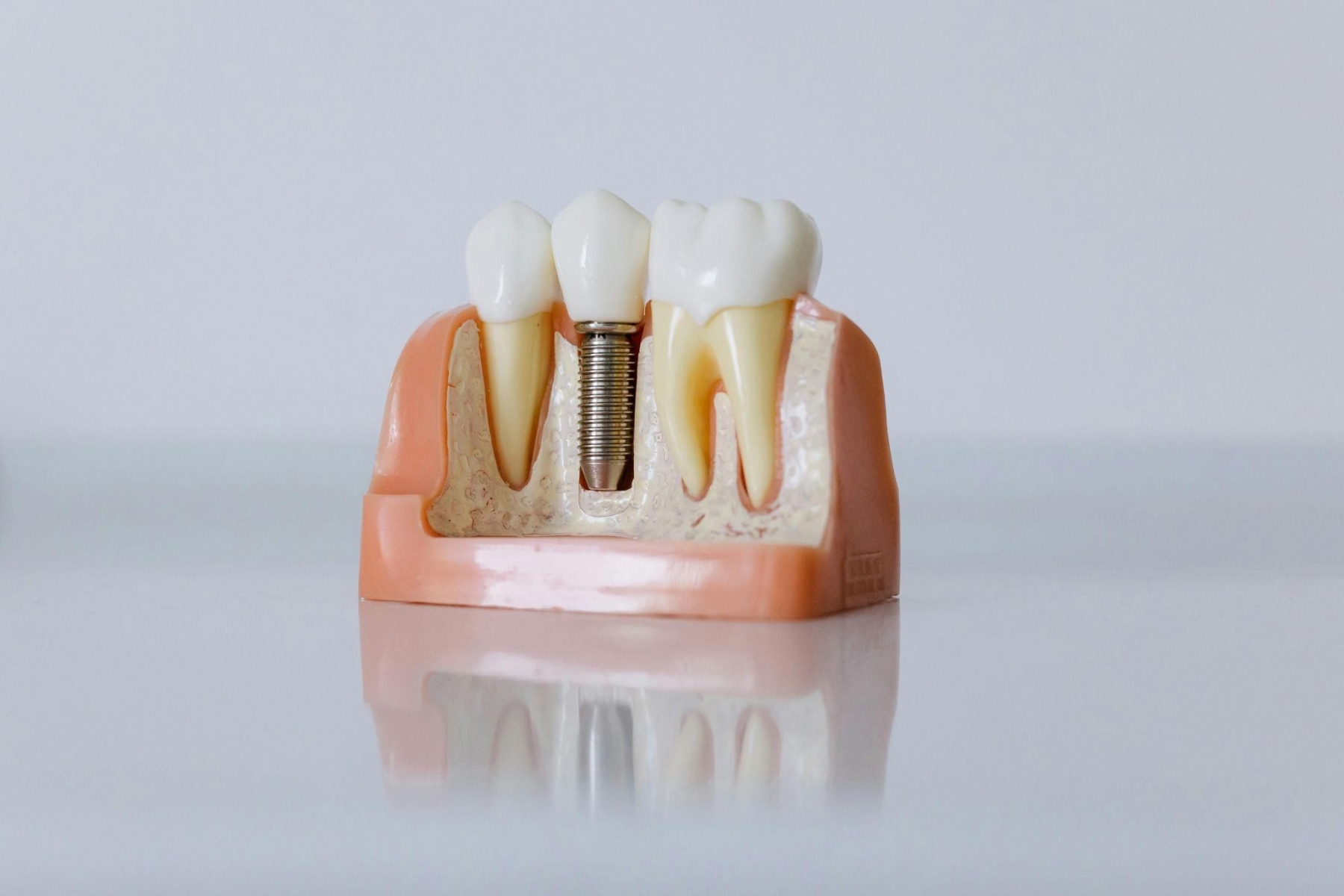 Trust the expert dentist at Dental Concepts: Transform your smile with advanced dental implants