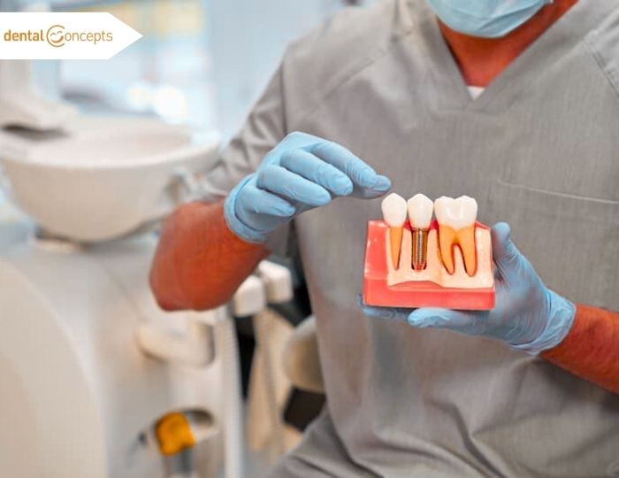 Dental Implants: The Permanent Solution to Missing Teeth 