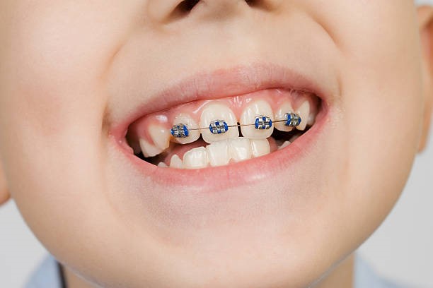 Why Opting for Teeth Straightening for Children Early is Best