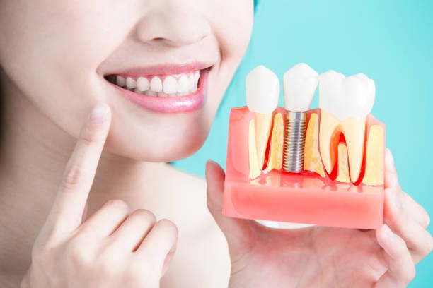 Why dental implants have become so popular