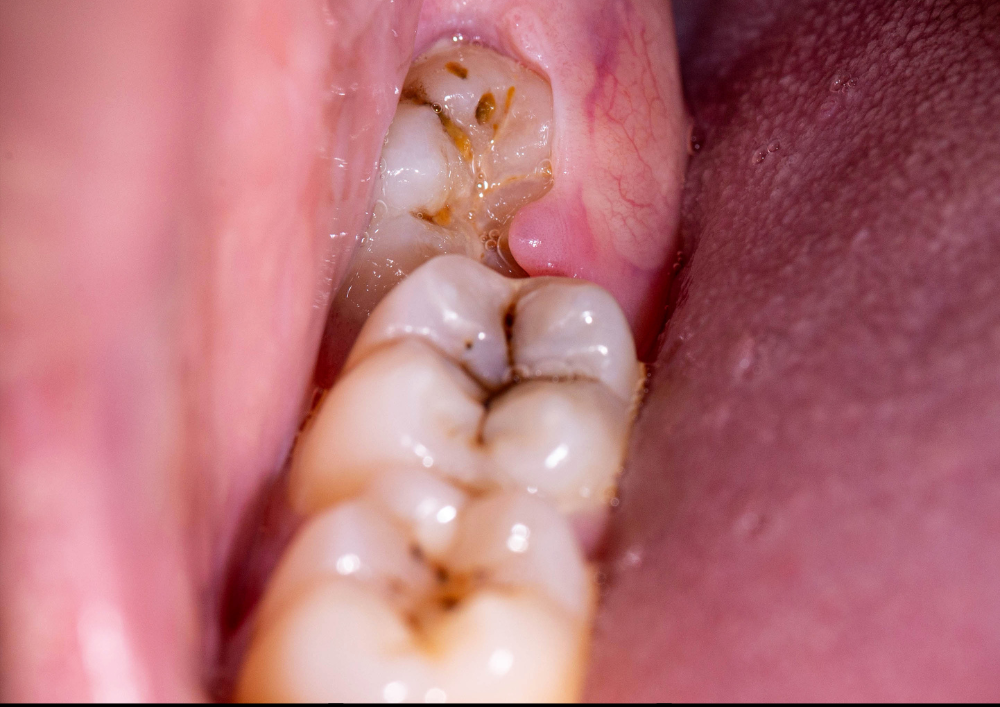 Wisdom Tooth Pain? Get a Same-Day Removal Appointment