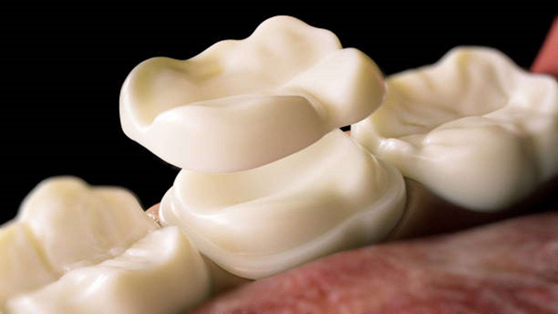 Recognising Indications for Replacing Your Dental Crowns