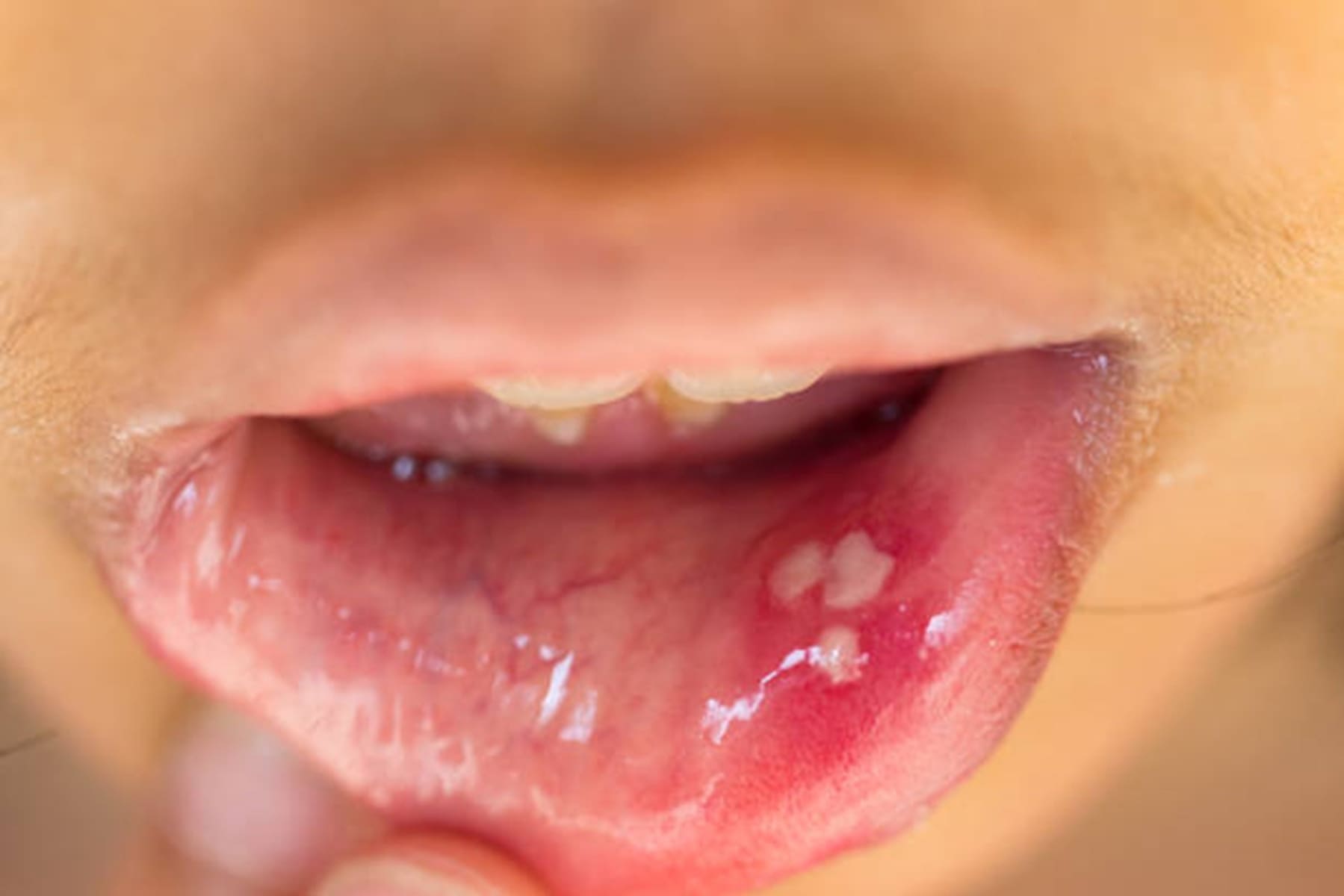 The truth about mouth ulcers